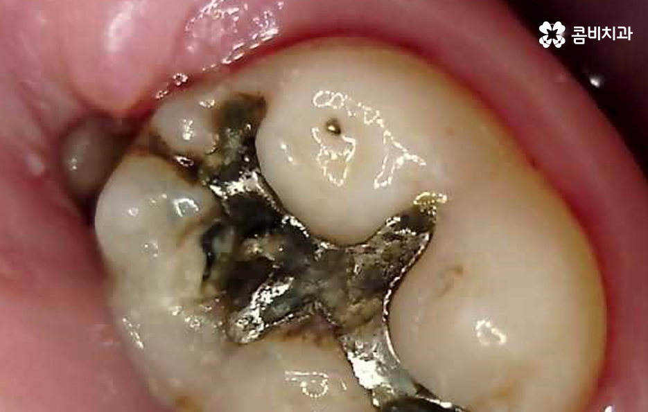 어금니 충치치료 깔끔하게 해결하려면 관련 이미지 8