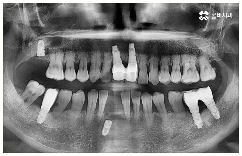 원데이임플란트 어떤가요? 관련 이미지 2