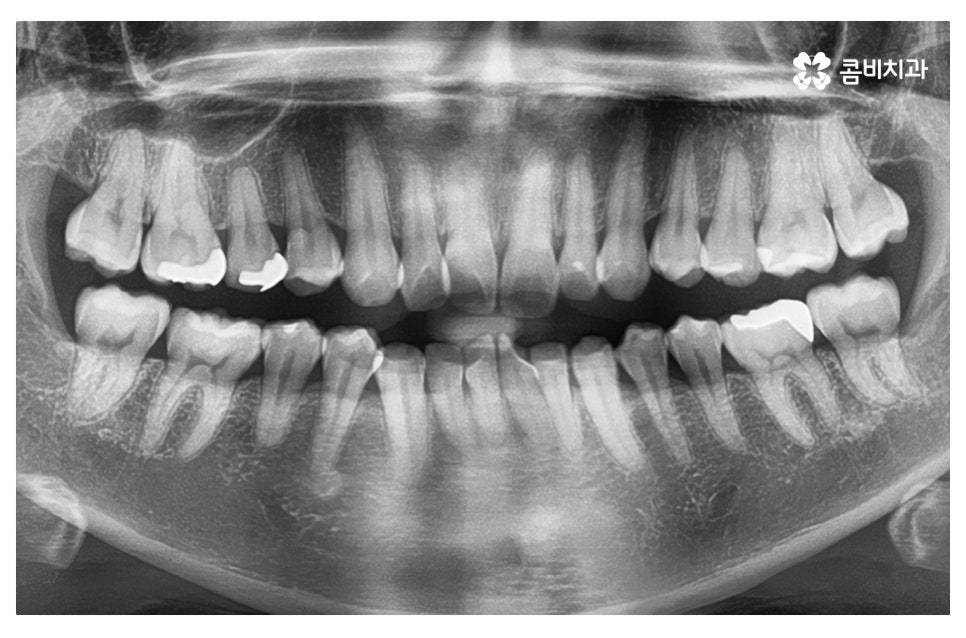 덧니교정 정확하게 알아보려면 관련 이미지 6
