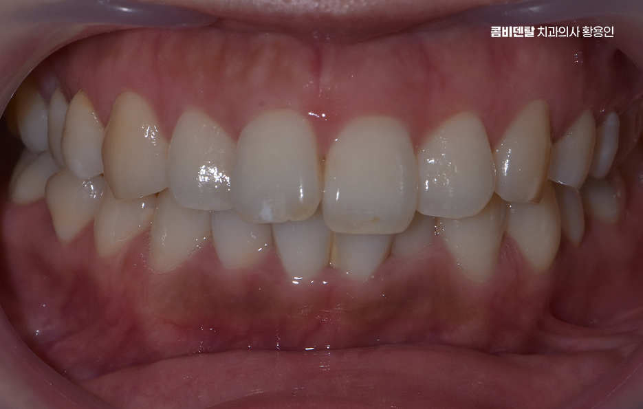 앞니 부분 교정 간단하니까 좋은건가요 관련 이미지 1