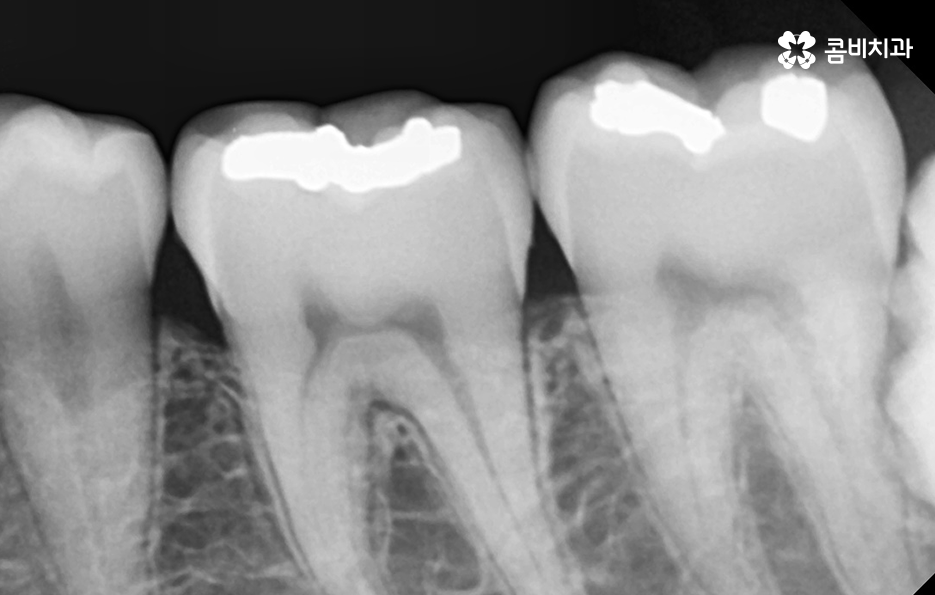어금니 충치치료 깔끔하게 해결하려면 관련 이미지 4