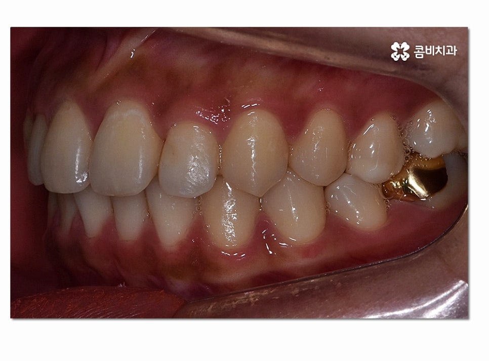앞니 부분교정 오래 걸리지 않고 원하는 부위만 관련 이미지 12