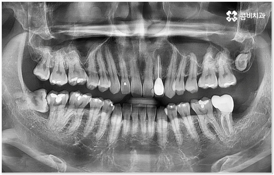 치아 사이 충치 어떻게 하나요 관련 이미지 5
