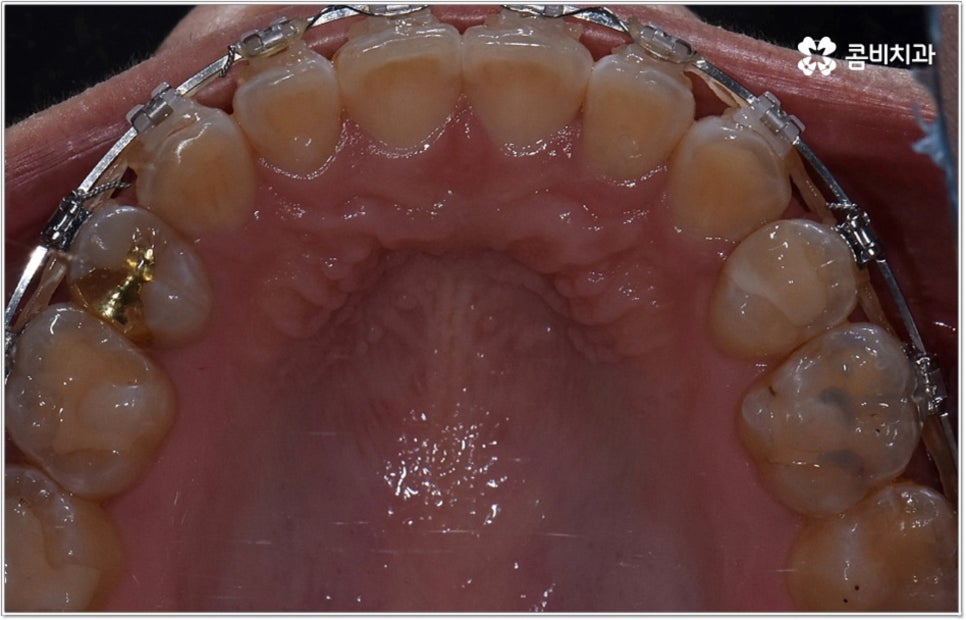 비발치치아교정 언제 할수있나요 관련 이미지 8