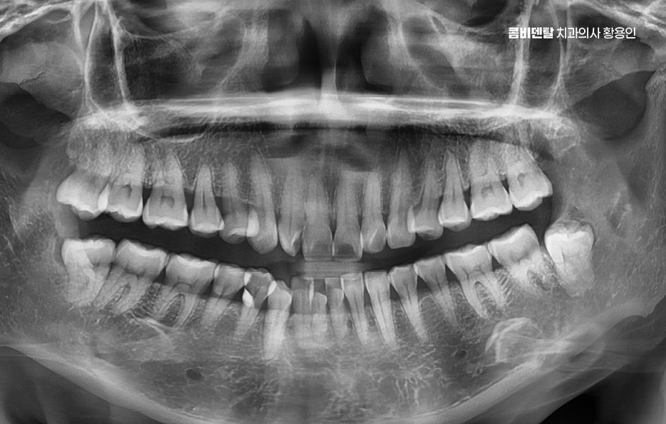 아래 사랑니 발치 통증 미리 알고 대처하려면 관련 이미지 5