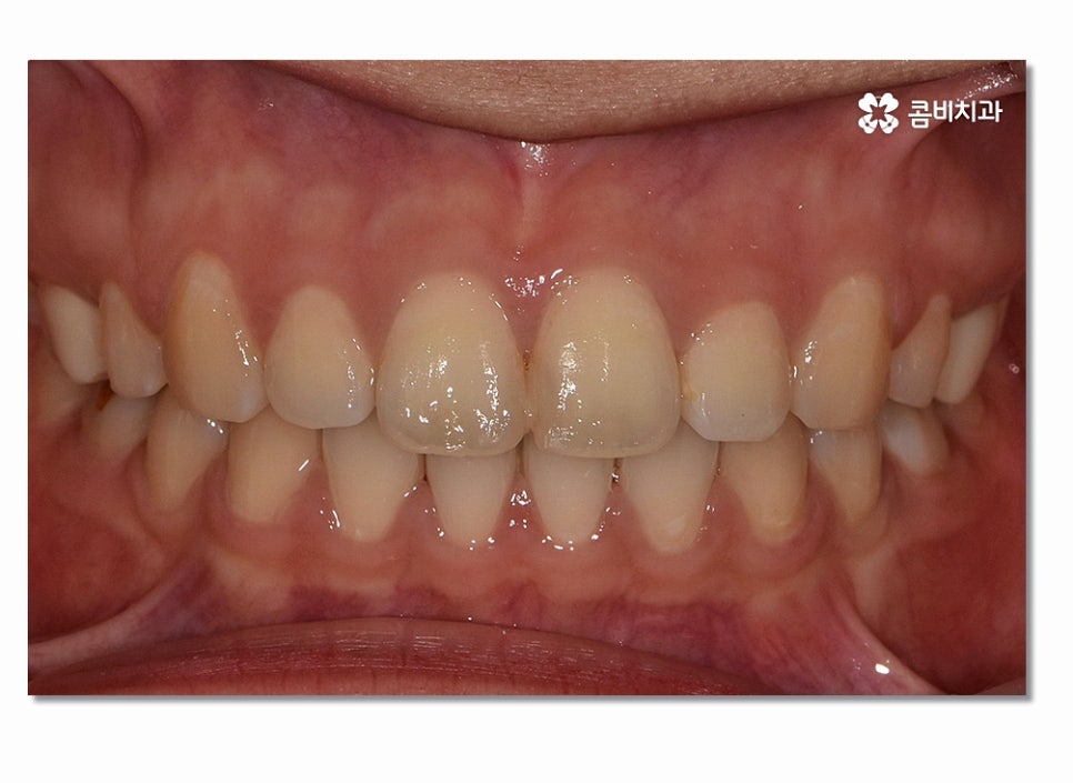 돌출입치아교정 부담이 크게 느껴진다면 관련 이미지 11