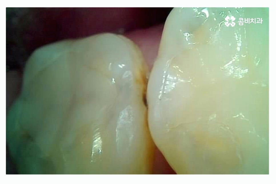 충치 레진 인레이 합리적으로 결정하려면 관련 이미지 4