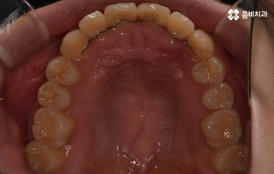 덧니 비발치 교정 자연스럽게 가능한 경우도 있어요 관련 이미지 10