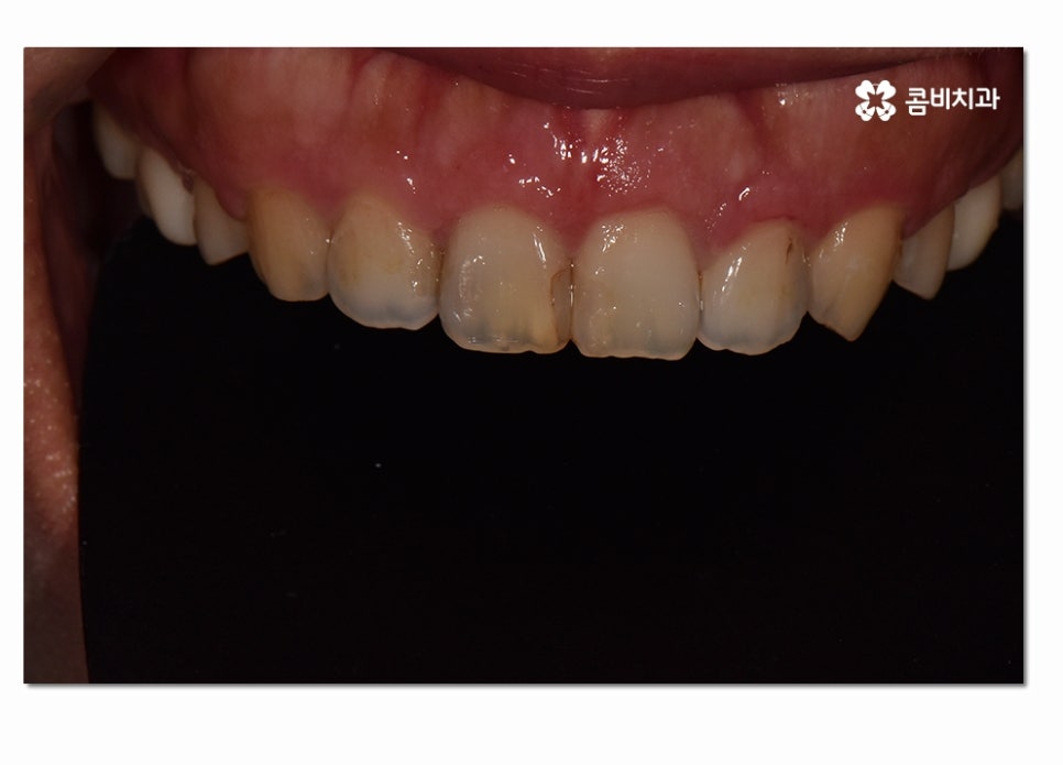 치주질환 치료의 중요성과 치은절제술이 활용된 사례 관련 이미지 7