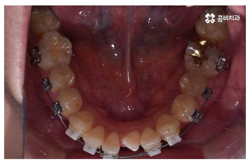 덧니교정 정확하게 알아보려면 관련 이미지 10