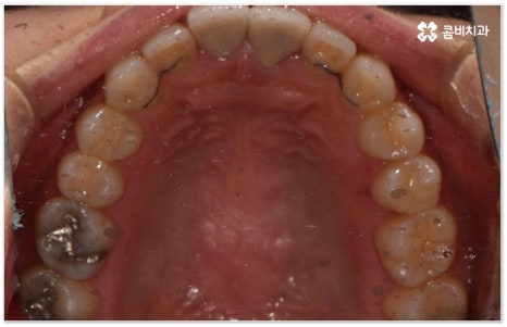치아교정장치 어떻게 고르나요 관련 이미지 17