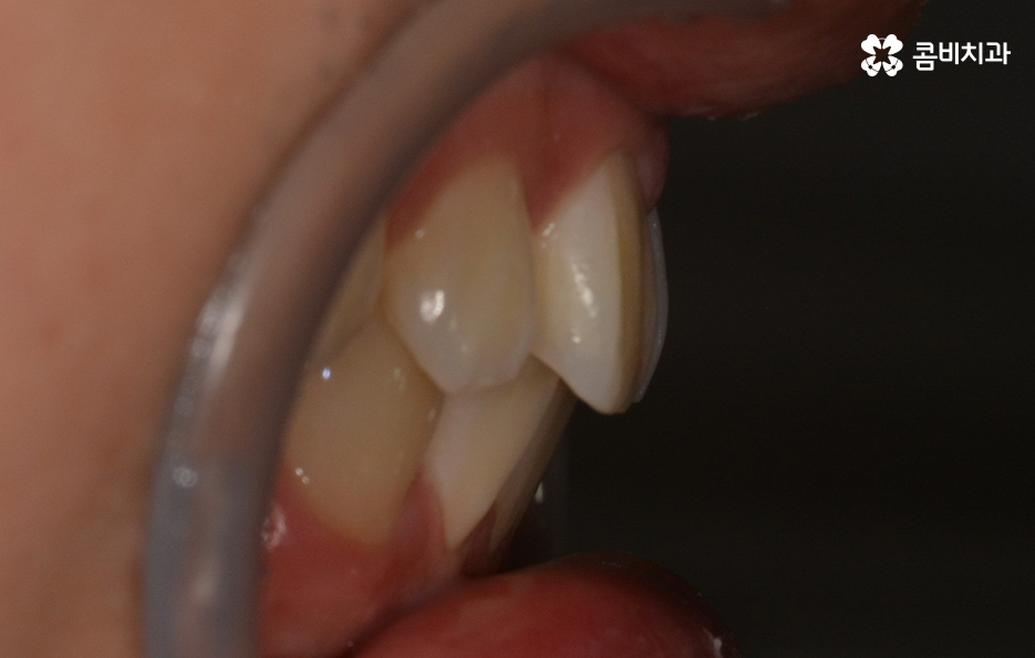 치아부분교정 내게도 적합한지 알아보려면 관련 이미지 5