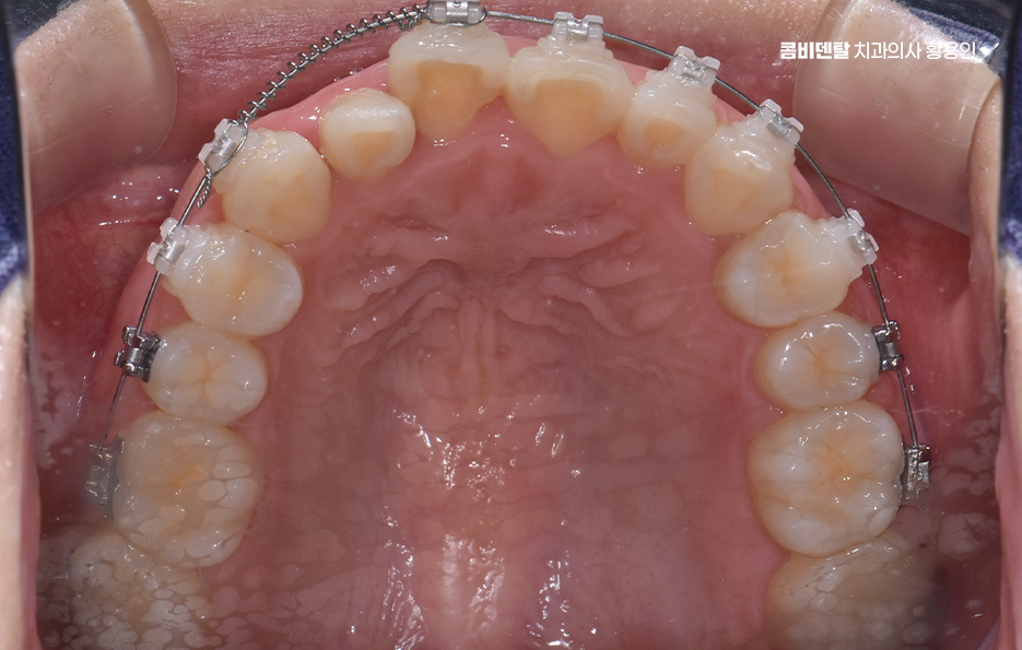 치아교정 통증 줄이는 방법 어떻게 가능할까요 관련 이미지 9