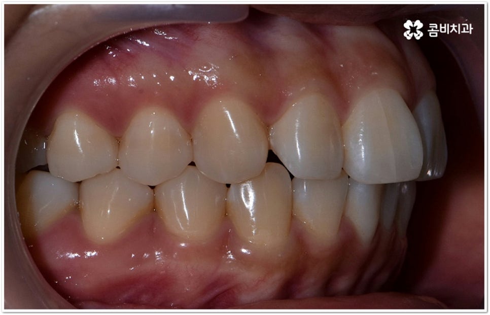 덧니부분교정 시작하려면 관련 이미지 4