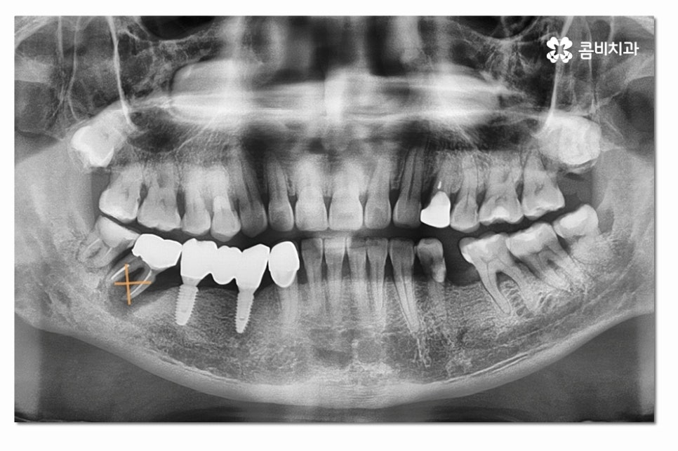 어금니임플란트 합리적으로 알아보려면 관련 이미지 1