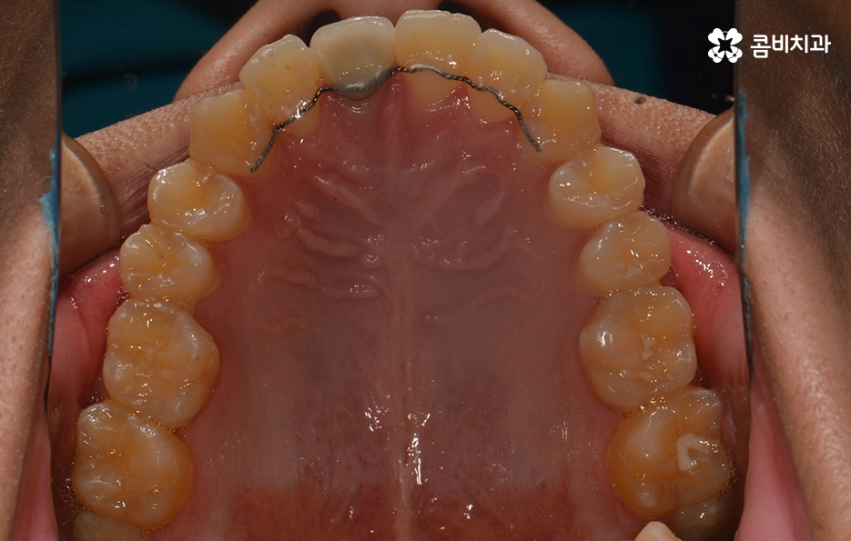 덧니교정 불편함이 느껴지지 않더라도 관련 이미지 14