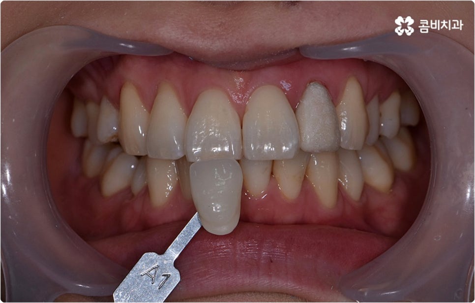 치아미백시술 관심있다면 관련 이미지 6