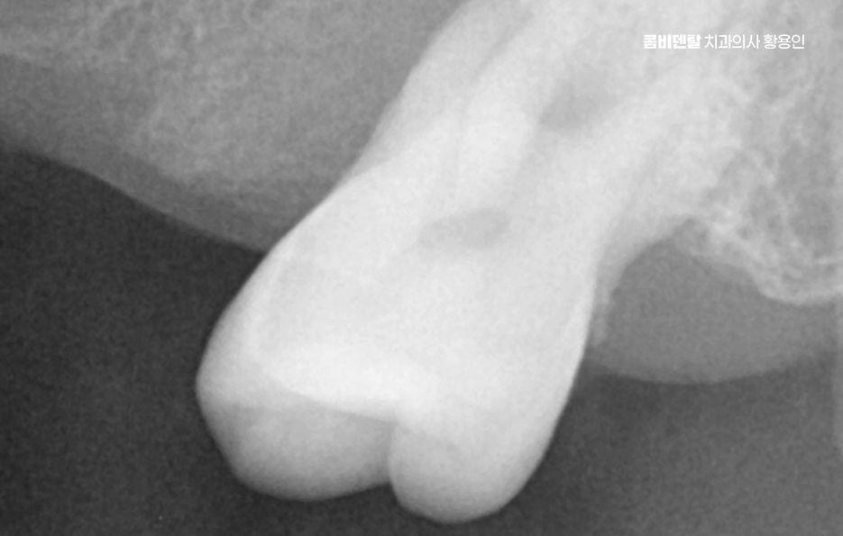 50대임플란트 꼼꼼하게 따져봐야할 포인트는 관련 이미지 4
