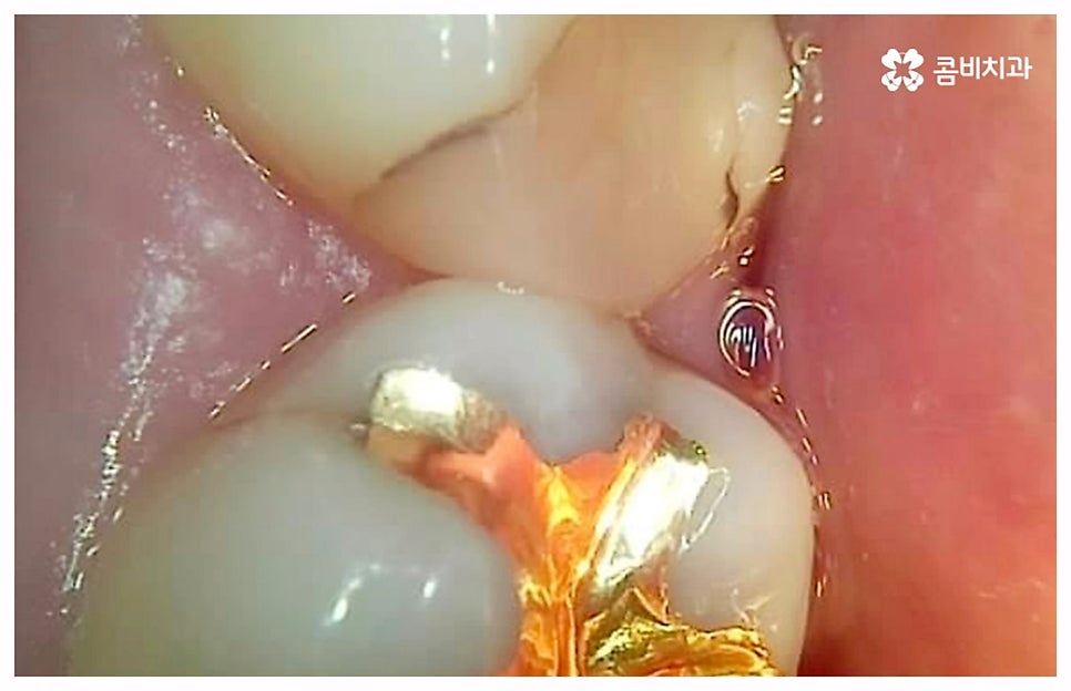 치통이 심할때 어떻게 해야하나요 관련 이미지 4