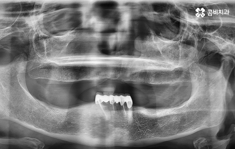 65세이상임플란트 고령이기에 간과하지 말아야 할 사항은 관련 이미지 1