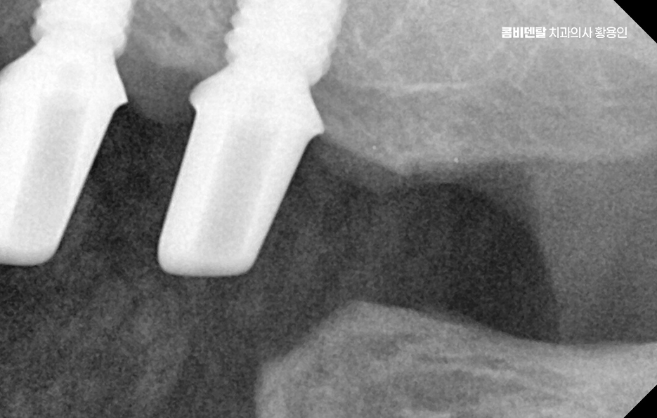 If You’re Considering Full Upper-Arch Implants for the Long Term image 8
