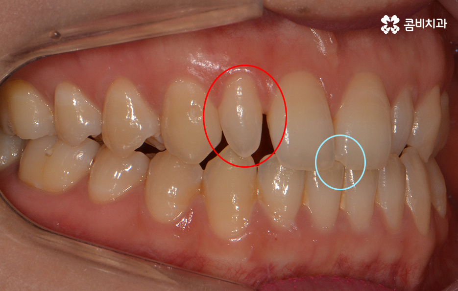 앞니 깨짐 치료와 교정이 병행되었던 사례 관련 이미지 2