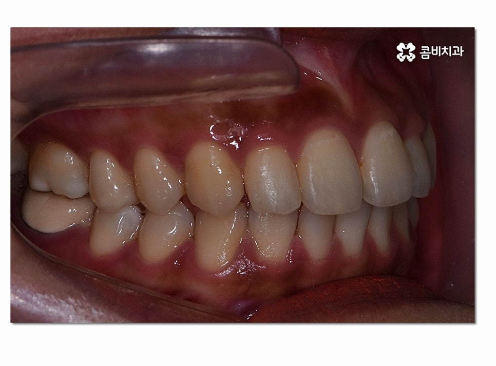 앞니 부분교정 오래 걸리지 않고 원하는 부위만 관련 이미지 11