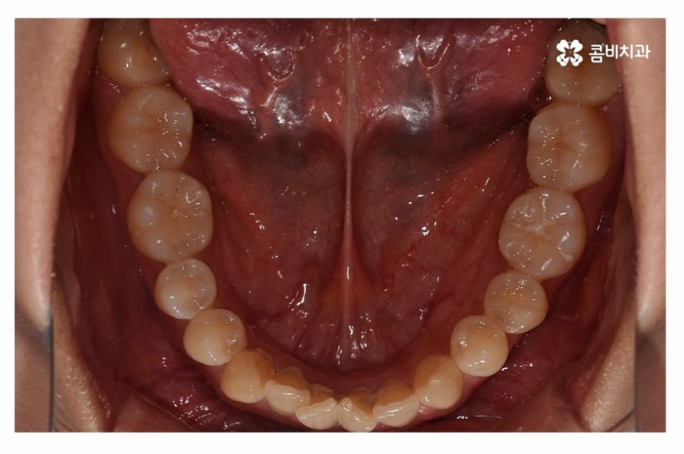덧니교정 체계적으로 준비하려면 관련 이미지 4