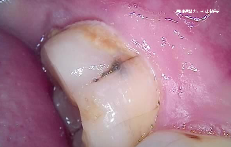치아 시림 통증 갈수록 심해지다면 관련 이미지 12
