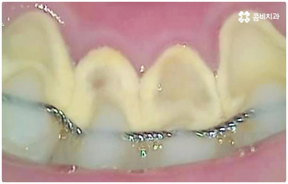 충치치료종류 알아볼까요? 관련 이미지 9