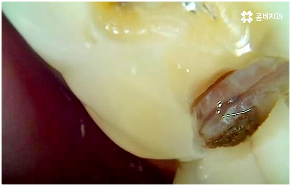 명동치과 평소에 케어하기 관련 이미지 9