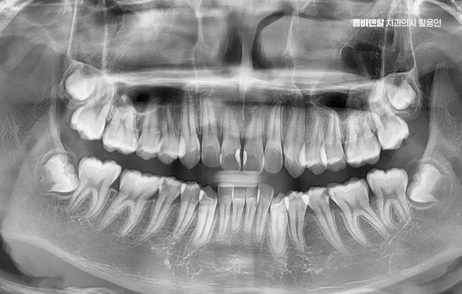 부정교합 교정 안하면 생기는 문제는 뭔가요 관련 이미지 7