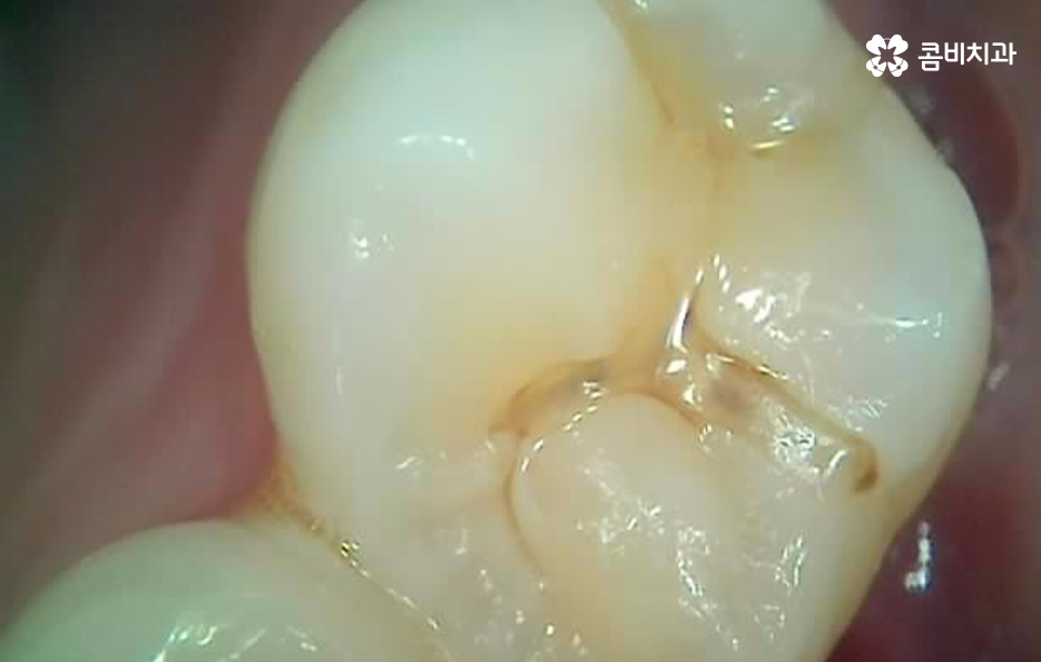 어금니 레진 깨짐 변색 안아파도 이렇게 대처하세요 관련 이미지 9