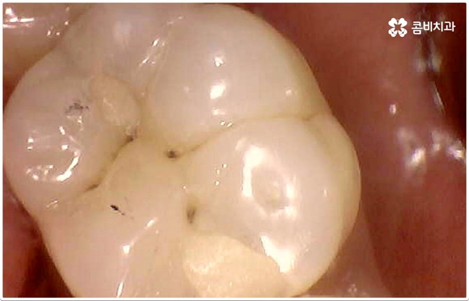 치아사이충치 놔두면 안돼요 관련 이미지 6