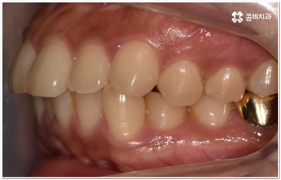 돌출입교정치과 알아보는 기준은 관련 이미지 6