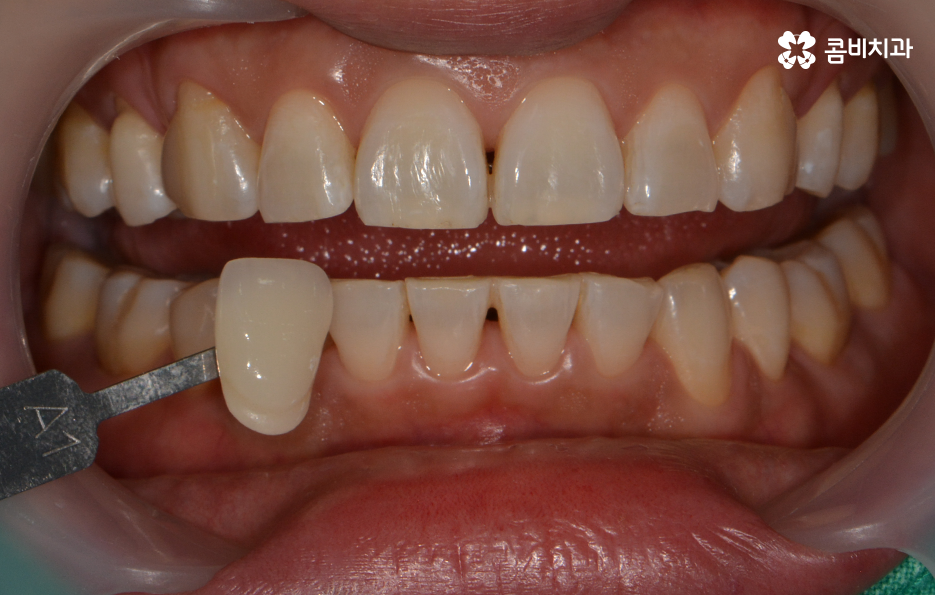 치과미백치료 누런 이가 고민되신다면 관련 이미지 6