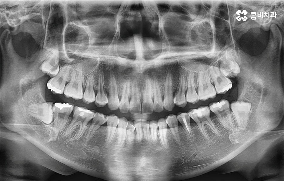 앞니 돌출 어떻게 고치나요? 관련 이미지 9