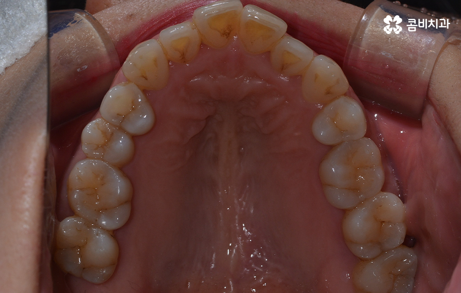 돌출입 콤비교정으로 얼굴까지 개선하는 방법은 관련 이미지 2