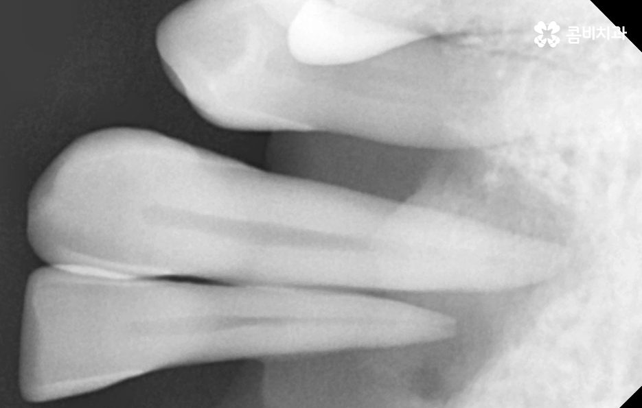 치아 옆면 충치 이렇게 무섭습니다 관련 이미지 9