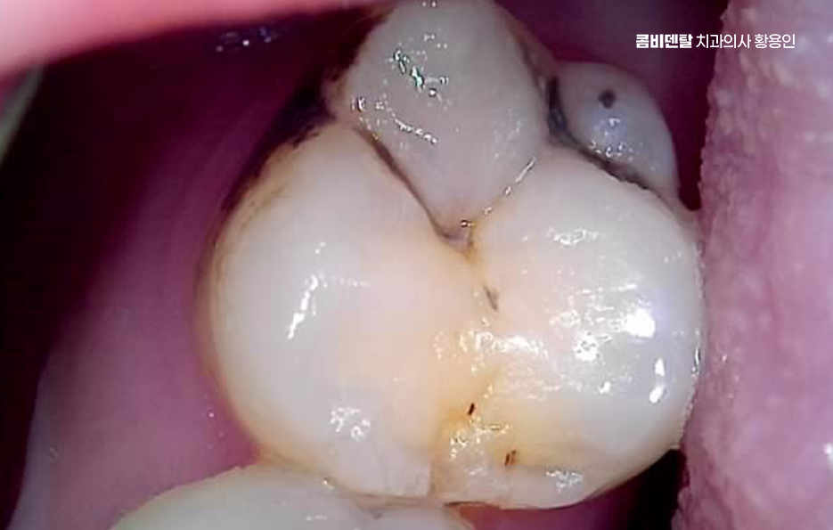 치아 시림 통증 갈수록 심해지다면 관련 이미지 11