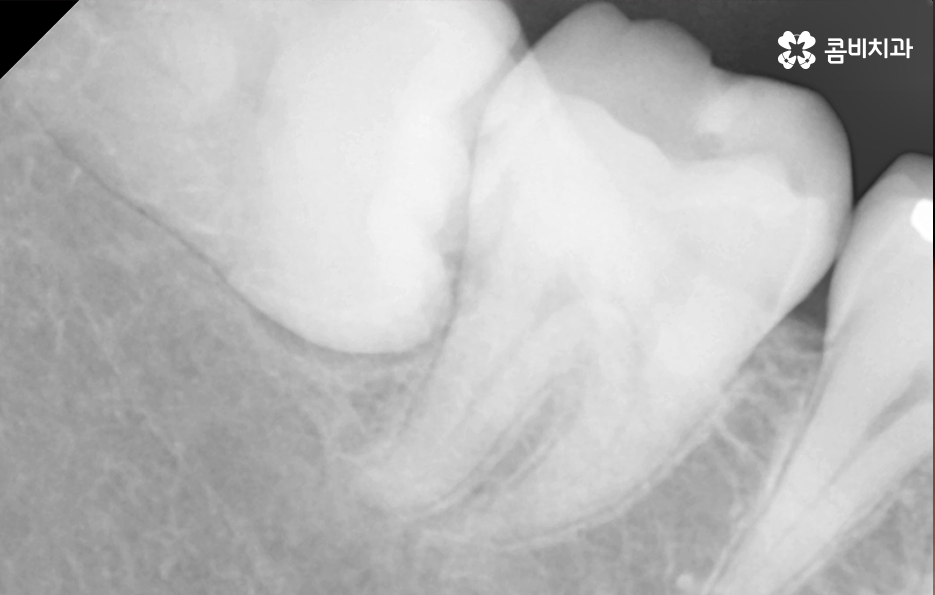 어금니 충치치료 깔끔하게 해결하려면 관련 이미지 9