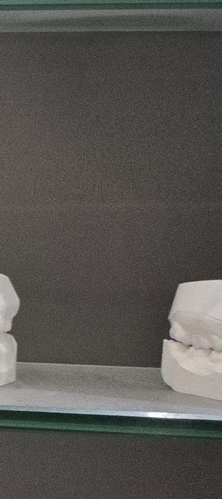 앞이빨 임플란트 과정 주의해야할 포인트는 관련 이미지 26