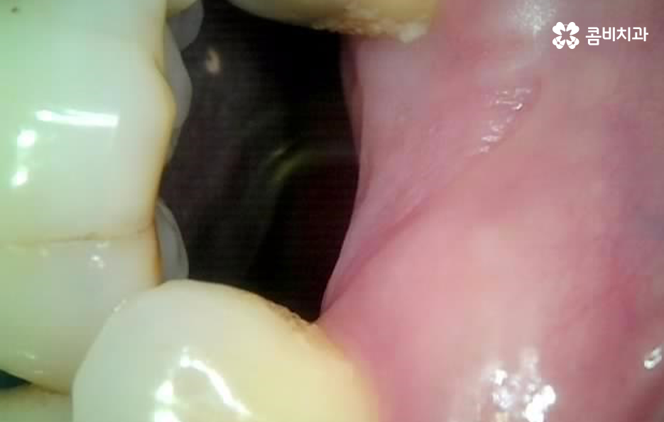 치아 옆면 충치 이렇게 무섭습니다 관련 이미지 3