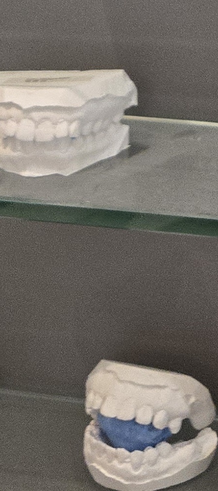 앞이빨 임플란트 과정 주의해야할 포인트는 관련 이미지 30