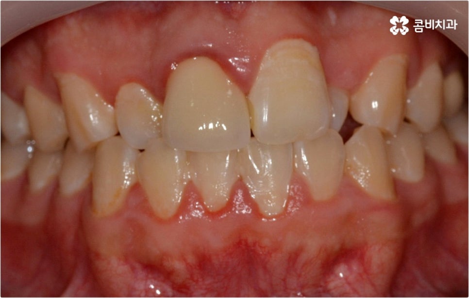 덧니교정 하고싶다면 관련 이미지 1