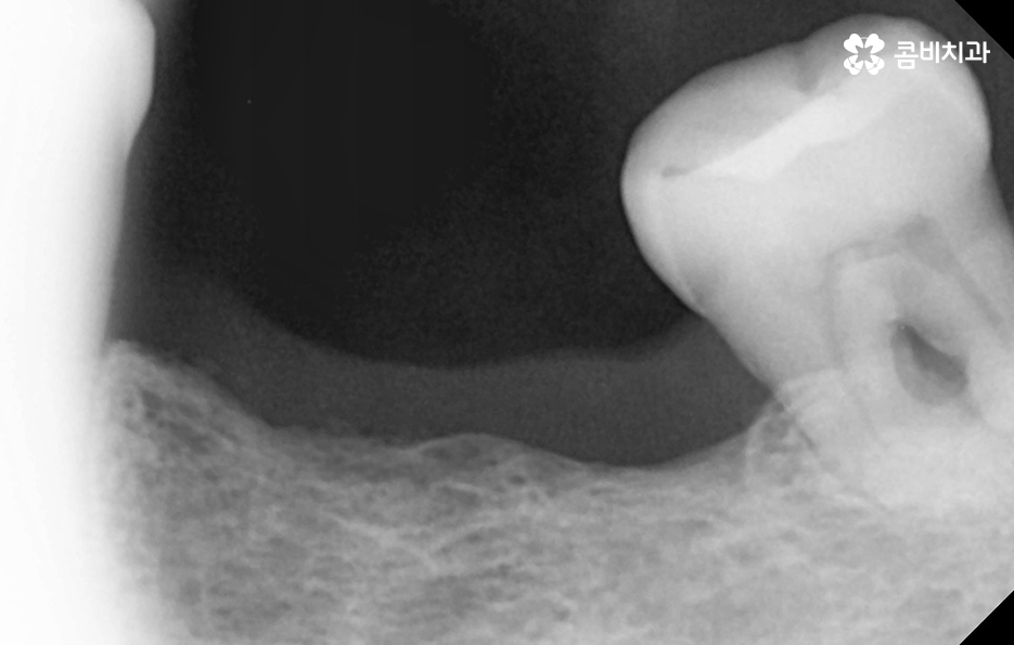 50대임플란트 각별하게 주의해야 하는 시기 관련 이미지 8