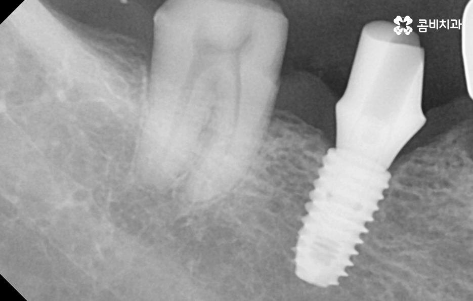노인임플란트 이때부터 특히 조심하세요 관련 이미지 12