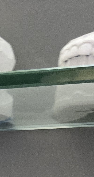 윗니 전체 임플란트 뭐부터 해야할까 관련 이미지 16