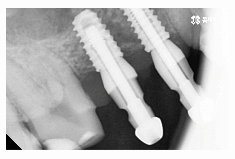 20대임플란트 갈수록 늘어나는 이유는 관련 이미지 10