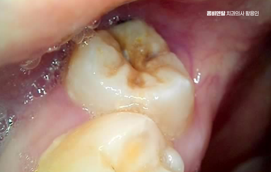 아래 사랑니 발치 통증 미리 알고 대처하려면 관련 이미지 2
